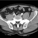 Degloving là gì? Nguyên nhân của Degloving