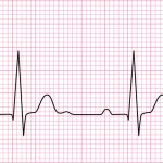 Ecg là gì? Chỉ số ecg bình thường là như thế nào? Cách đọc ecg trên các thiết bị đo