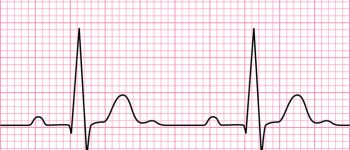 Ecg là gì? Chỉ số ecg bình thường là như thế nào? Cách đọc ecg trên các thiết bị đo