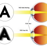 Loạn thị là gì? Nguyên nhân và cách điều trị